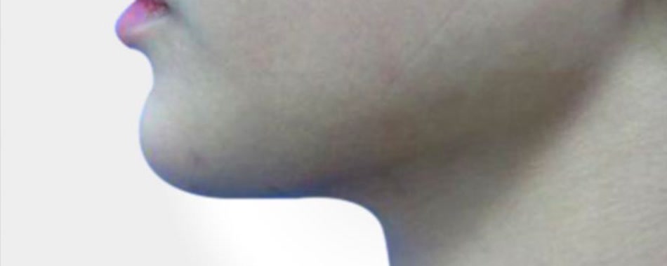 Double chin liposuction — after
