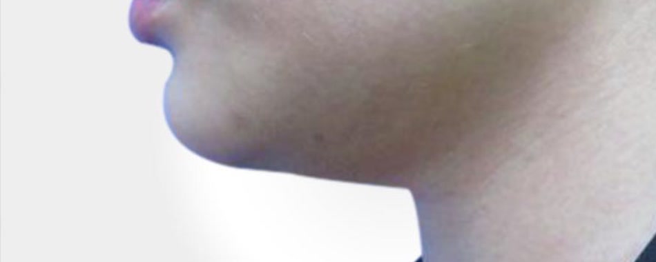 Double chin liposuction — before