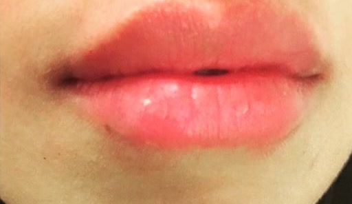 Lip filler — after