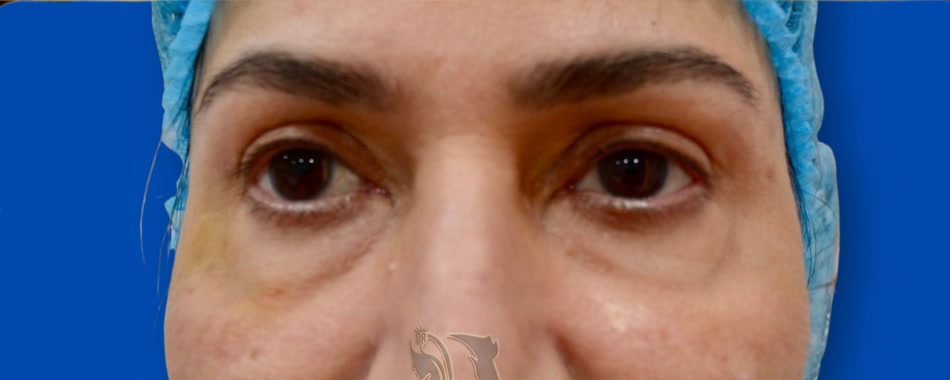 Lower blepharoplasty — before