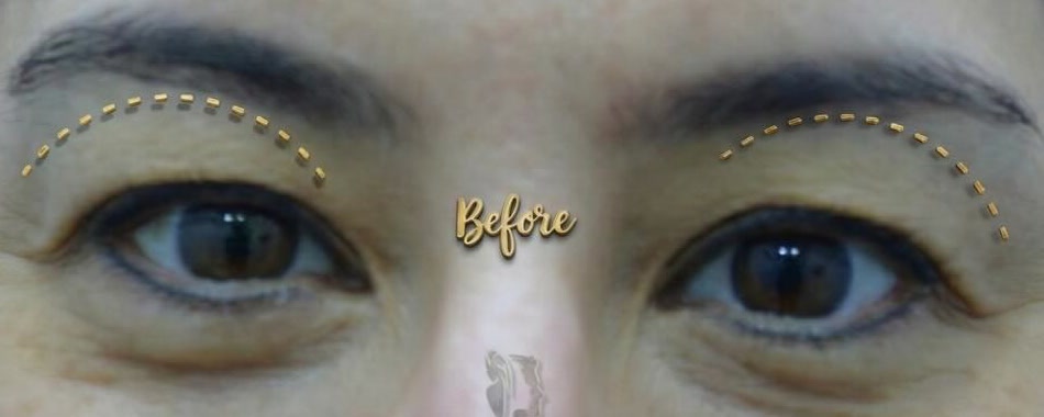 Upper blepharoplasty — before
